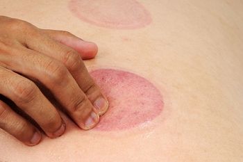Cupping Marks