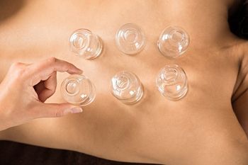 Cupping