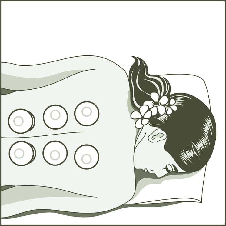 Cupping